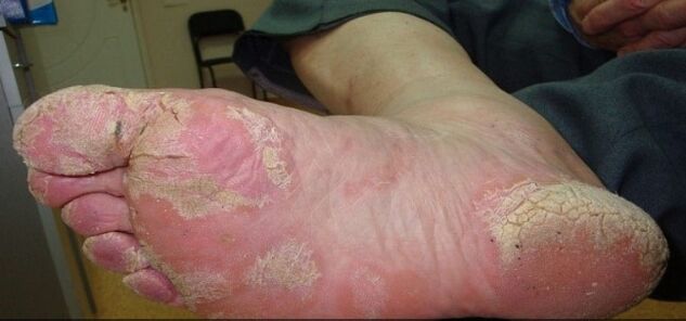 Psoriaas jalgadel