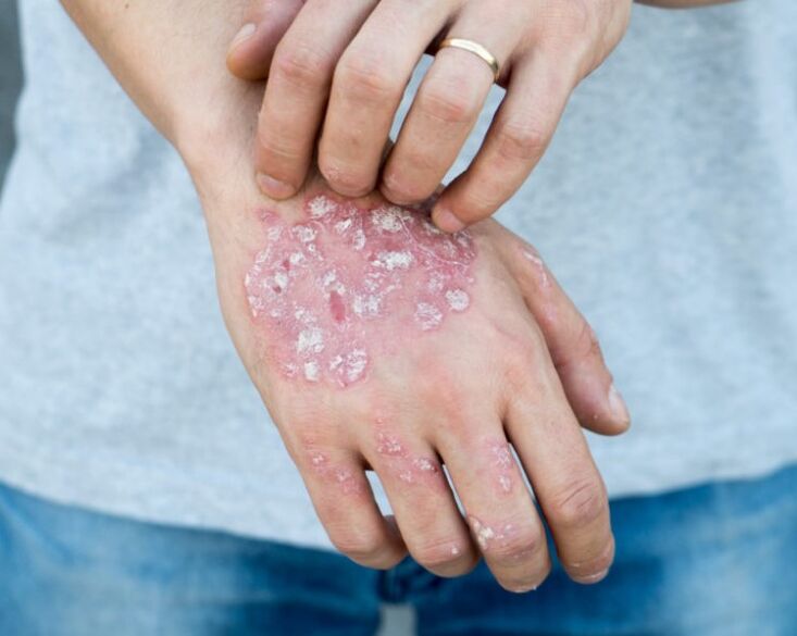 Psoriaas käes