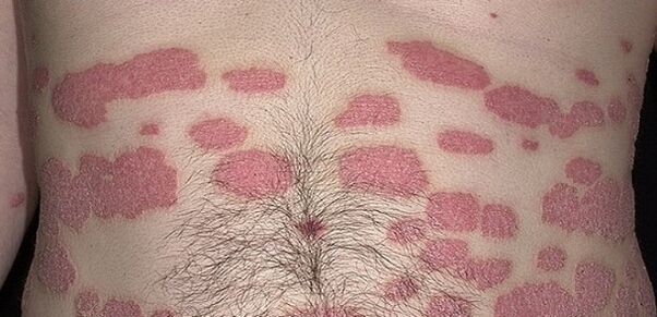 Psoriaas