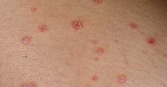 Psoriaatilised naastud