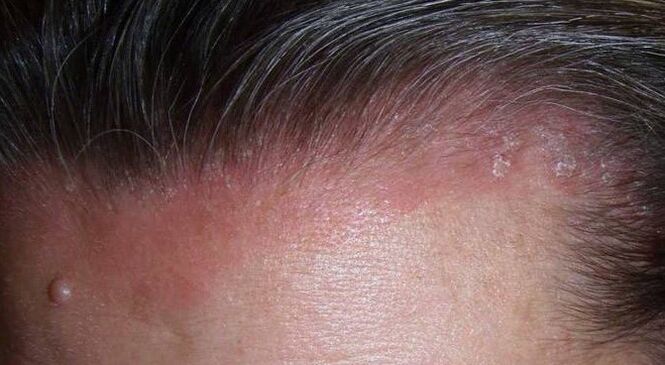 Mis on psoriaas