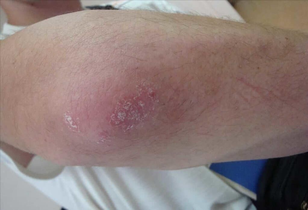 Kuidas psoriaas välja näeb