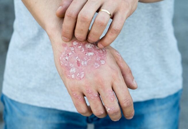 Mesnichered Psoriaas