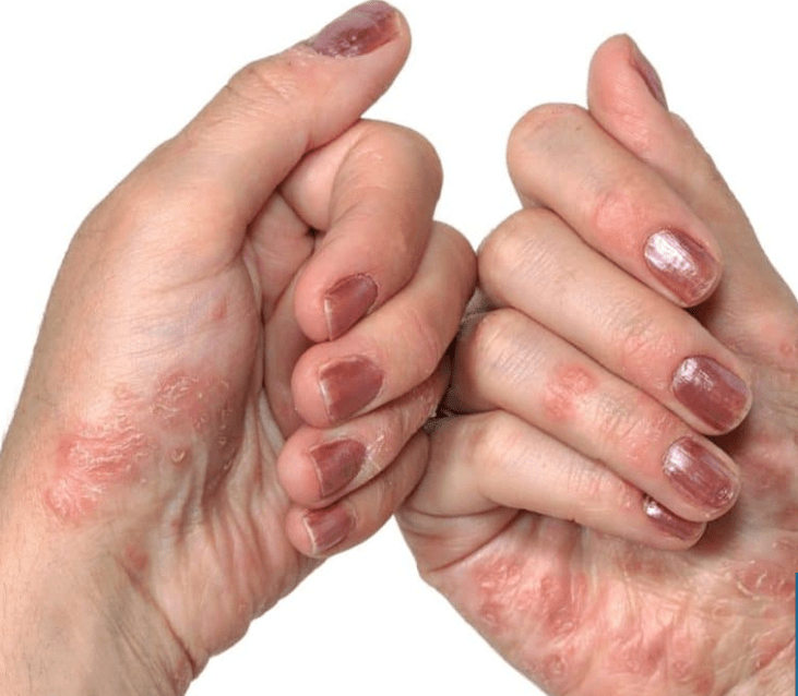 Psoriaas käes