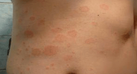 Õnnetu psoriaas