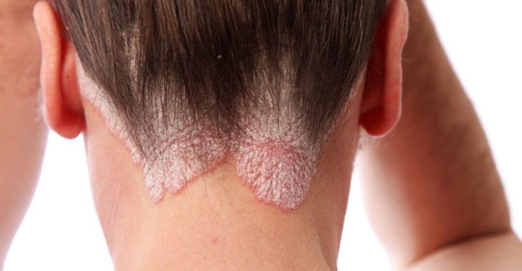 Psoriaas tüdrukute peas