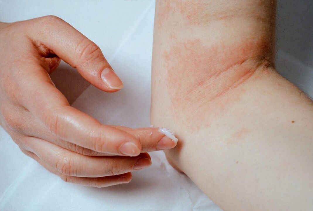Psoriaasi ravi