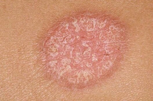 psoriaas