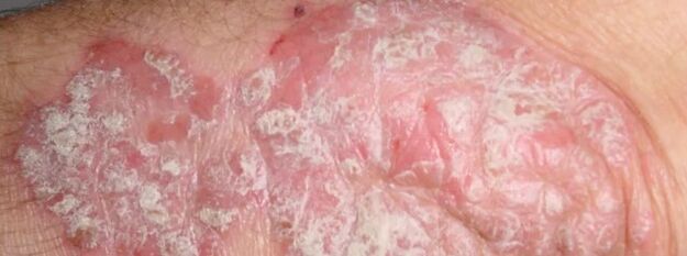 Mesnichered Psoriaas