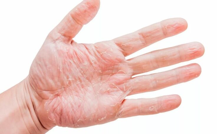 Psoriaas