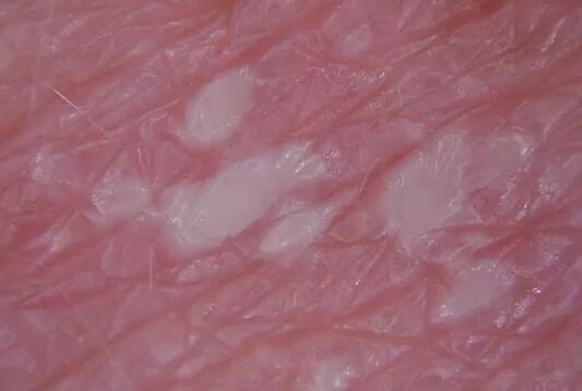 Pustulenia psoriaas