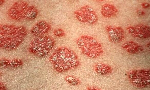 Psoriaasi vormid