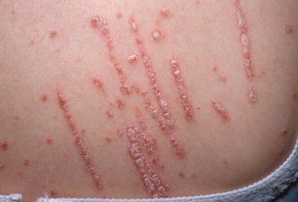 Psoriaas kehal