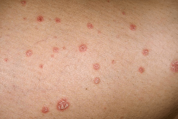 Psoriaatilised naastud