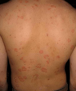 Naastuline psoriaas