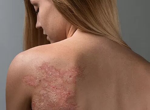 Psoriaas tüdruku seljas