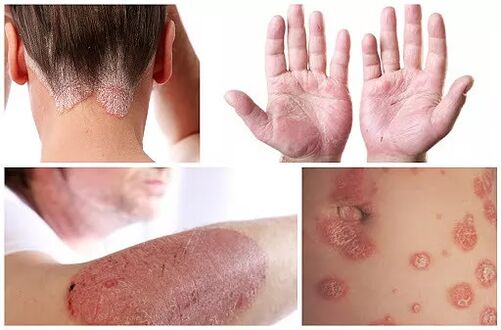 Psoriaasi ilmingud erinevatel kehaosadel