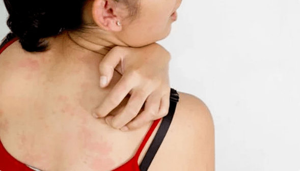 psoriaas