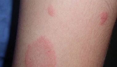 Kuidas psoriaasi esialgne staadium avaldub