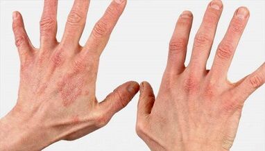 kuidas näeb välja psoriaasi esialgne staadium