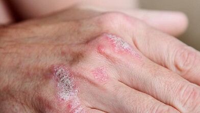 psoriaasi esialgse staadiumi sümptomid