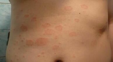 kuidas ära tunda psoriaasi algstaadium