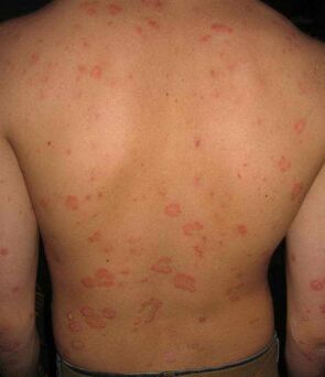 psoriaas seljal