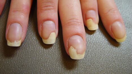 Psoriaasist tingitud valged laigud küüntel