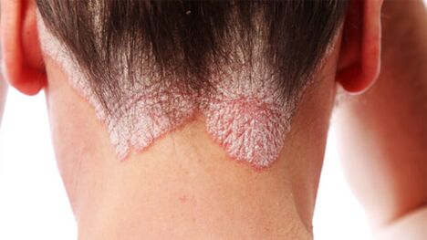 Psoriaatilised naastud peanahal