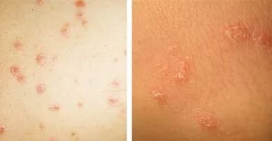 psoriaasi peamised ilmingud