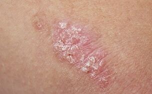 psoriaasi põhjused