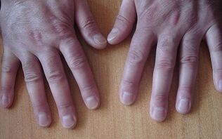 psoriaasi sümptomid algstaadiumis