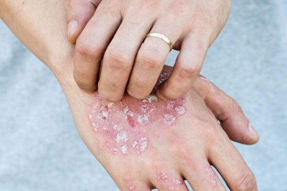 psoriaasi iseloomulikud sümptomid kätel